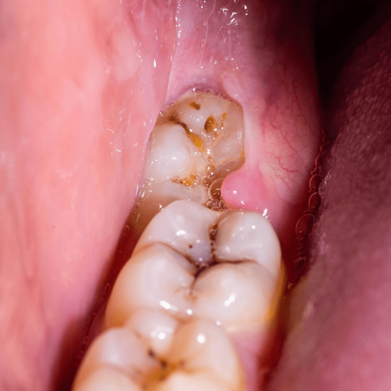 perikoronitis gigi bisa terjadi jika tidak segera operasi gigi bungsu