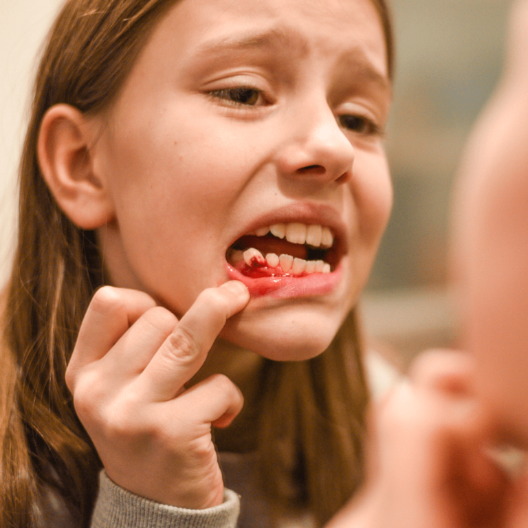 gigi goyang bisa terjadi jika tidak segera operasi gigi bungsu