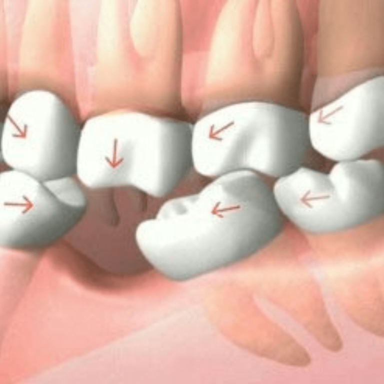 migrasi gigi atau gigi bergeser ke arah dimana tersedia lubang akibat gigi yang tanggal