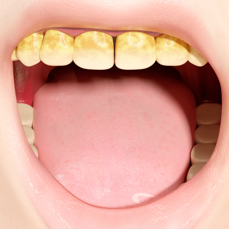 gigi yang tanggal bisa menyebabkan bau mulut, plak gigi, dan karang gigi