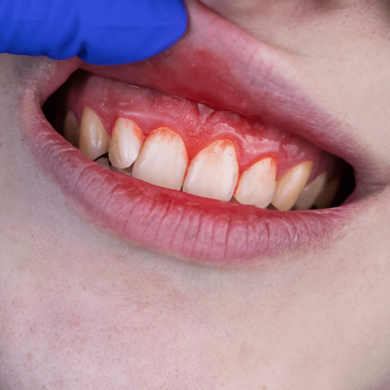 radang gigi bisa terjadi jika tidak segera operasi gigi bungsu