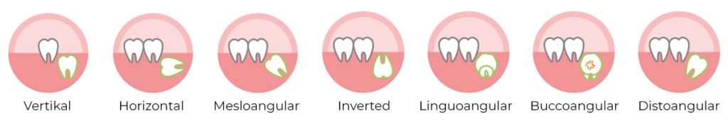 ciri ciri impaksi gigi dan perlu operasi gigi bungsu