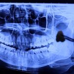 Pasien berkonsultasi sebelum odontektomi di Klinik Pondok Gigi Jakarta
