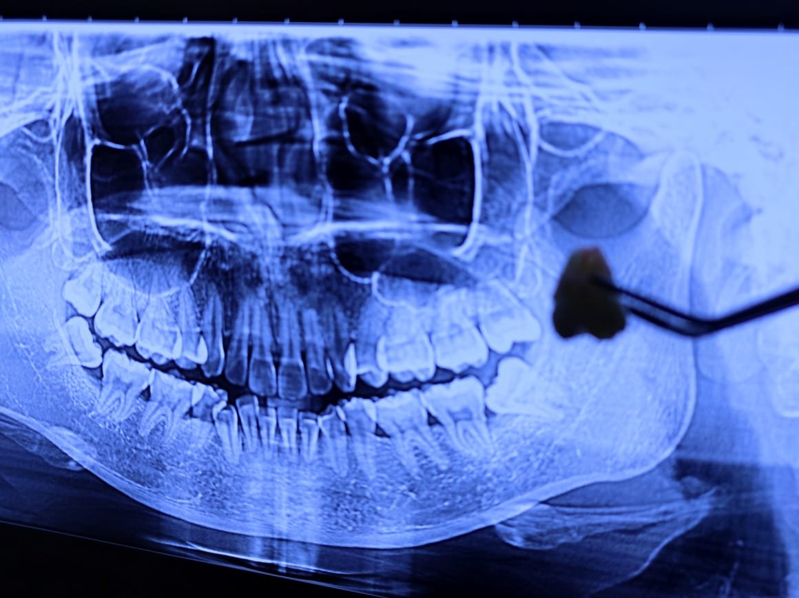Pasien berkonsultasi sebelum odontektomi di Klinik Pondok Gigi Jakarta