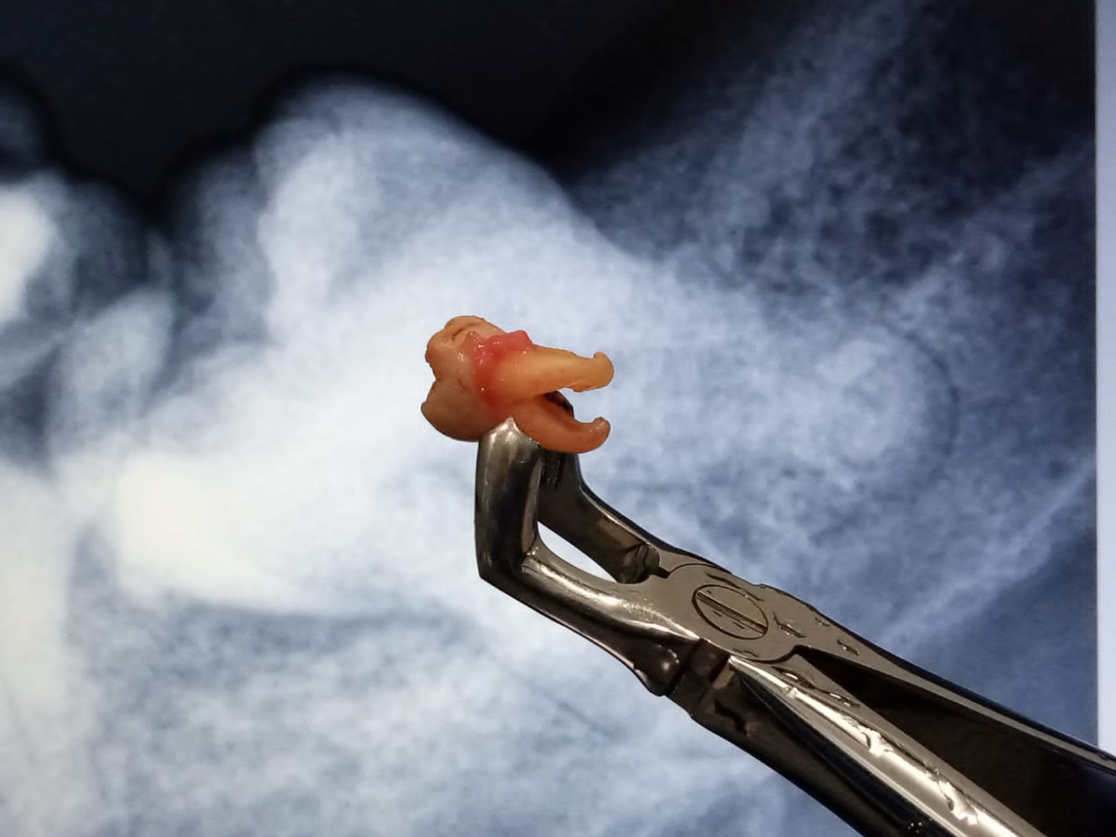 Pasien menerima resep obat setelah cabut gigi bungsu