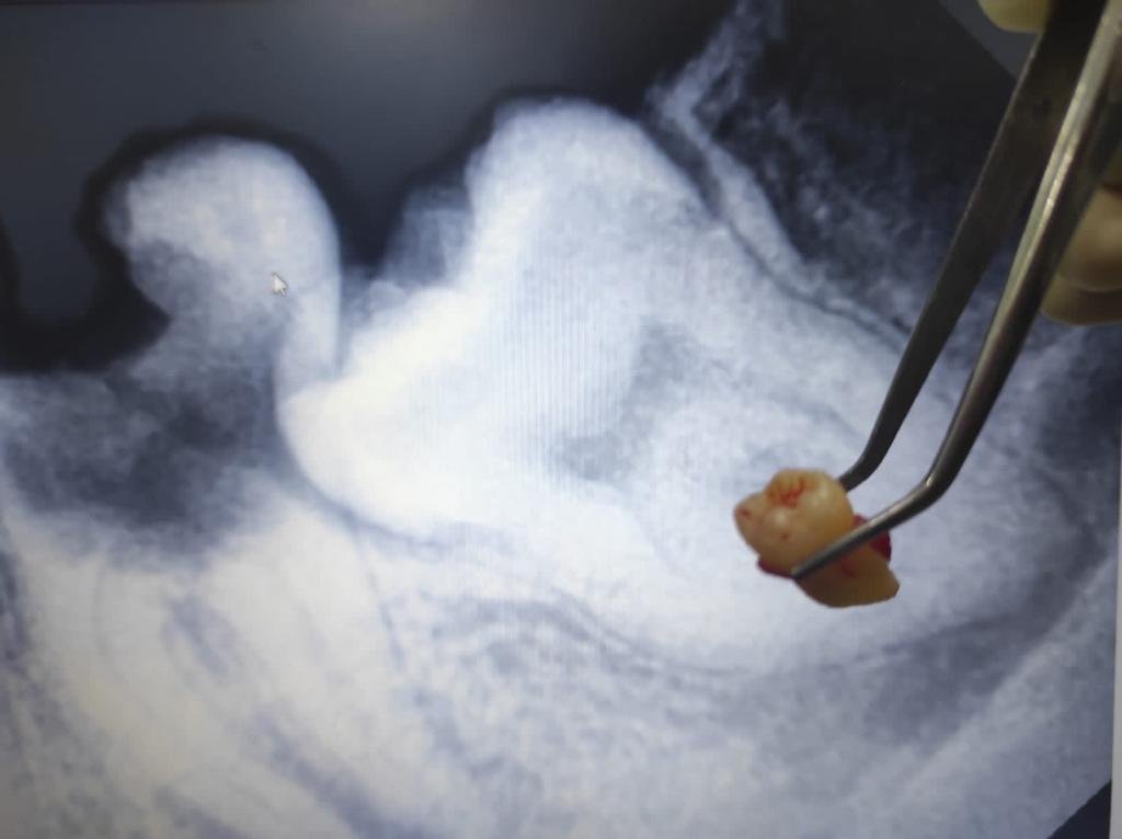 Dokter gigi melakukan sayatan kecil sebelum cabut gigi bungsu