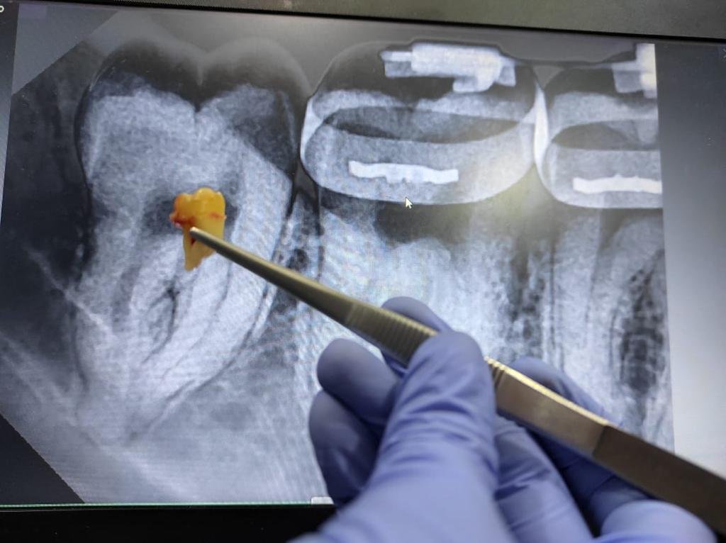 Kompres dingin untuk mengurangi bengkak setelah odontektomi