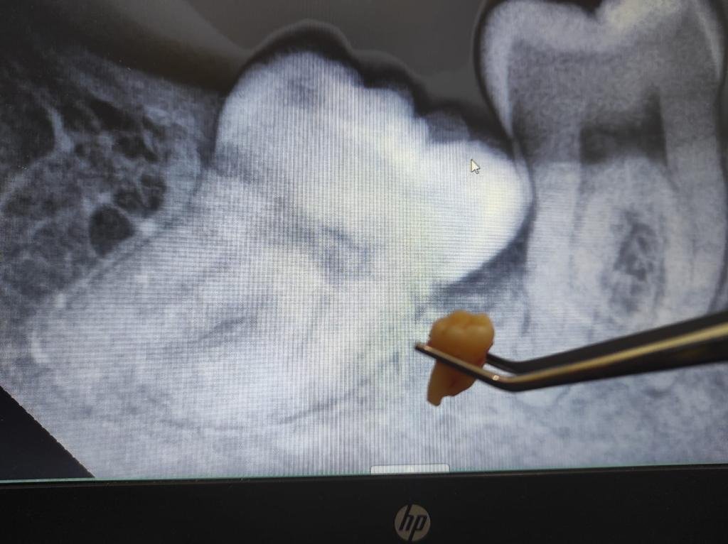 Odontektomi dengan bantuan alat bedah mulut