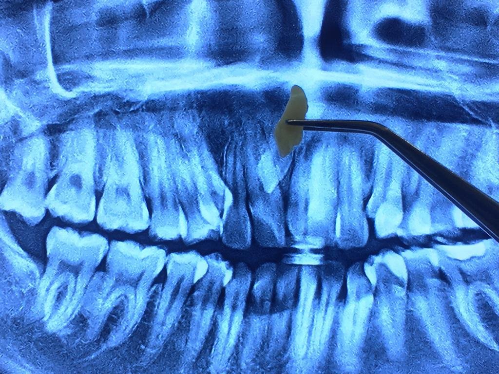 Bengkak pada pipi setelah cabut gigi bungsu
