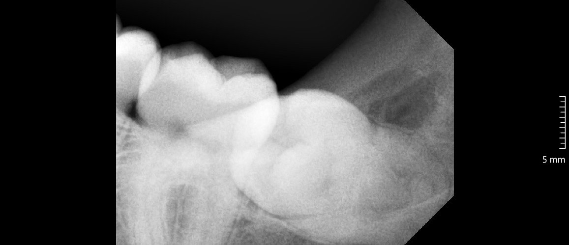 Perawatan luka setelah odontektomi gigi bungsu
