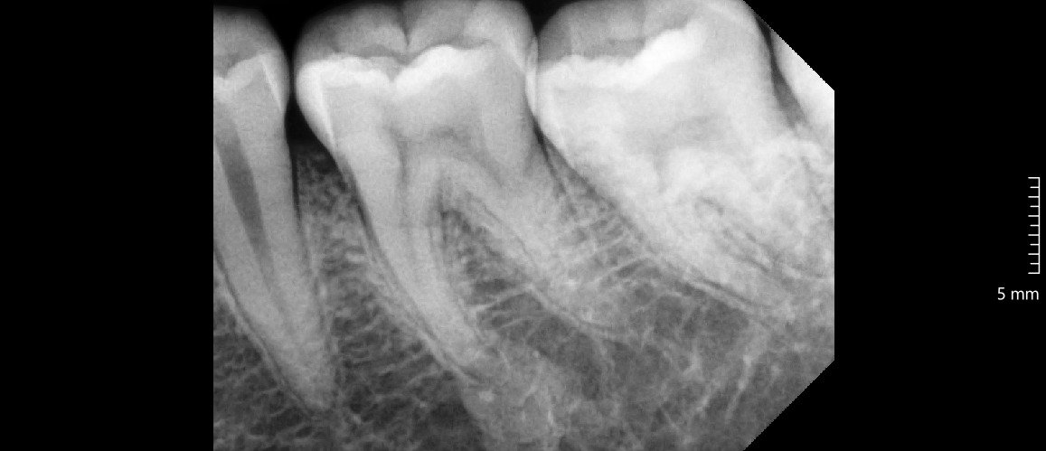 Pasien dilarang merokok setelah cabut gigi bungsu
