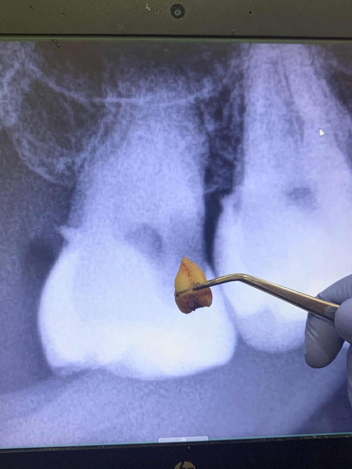 Ilustrasi kista rahang akibat gigi bungsu impaksi