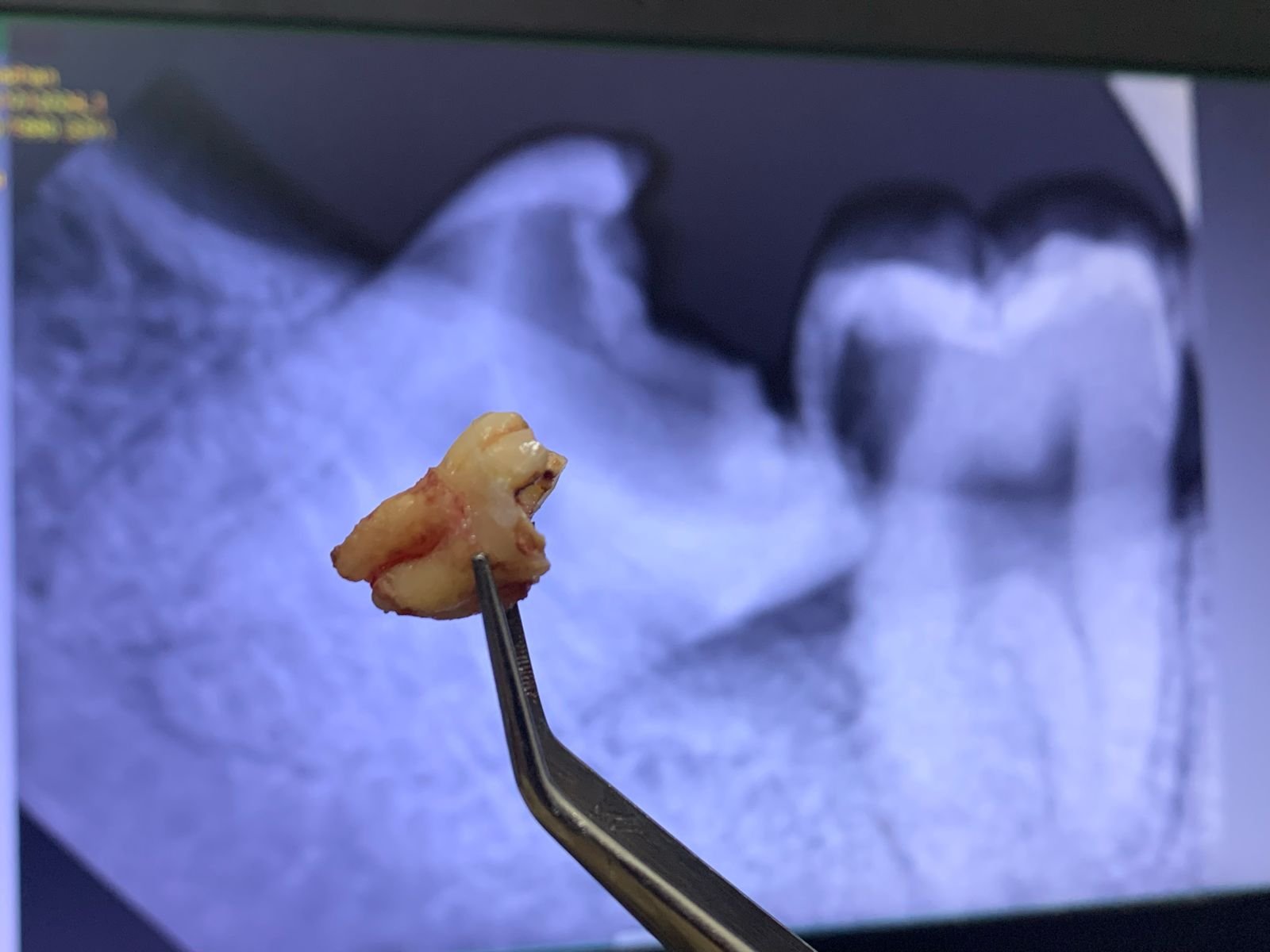 Pasien menjalani rontgen panoramic sebelum cabut gigi bungsu