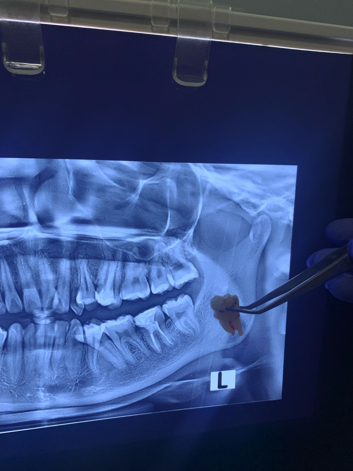 Dokter gigi menjelaskan prosedur odontektomi kepada pasien