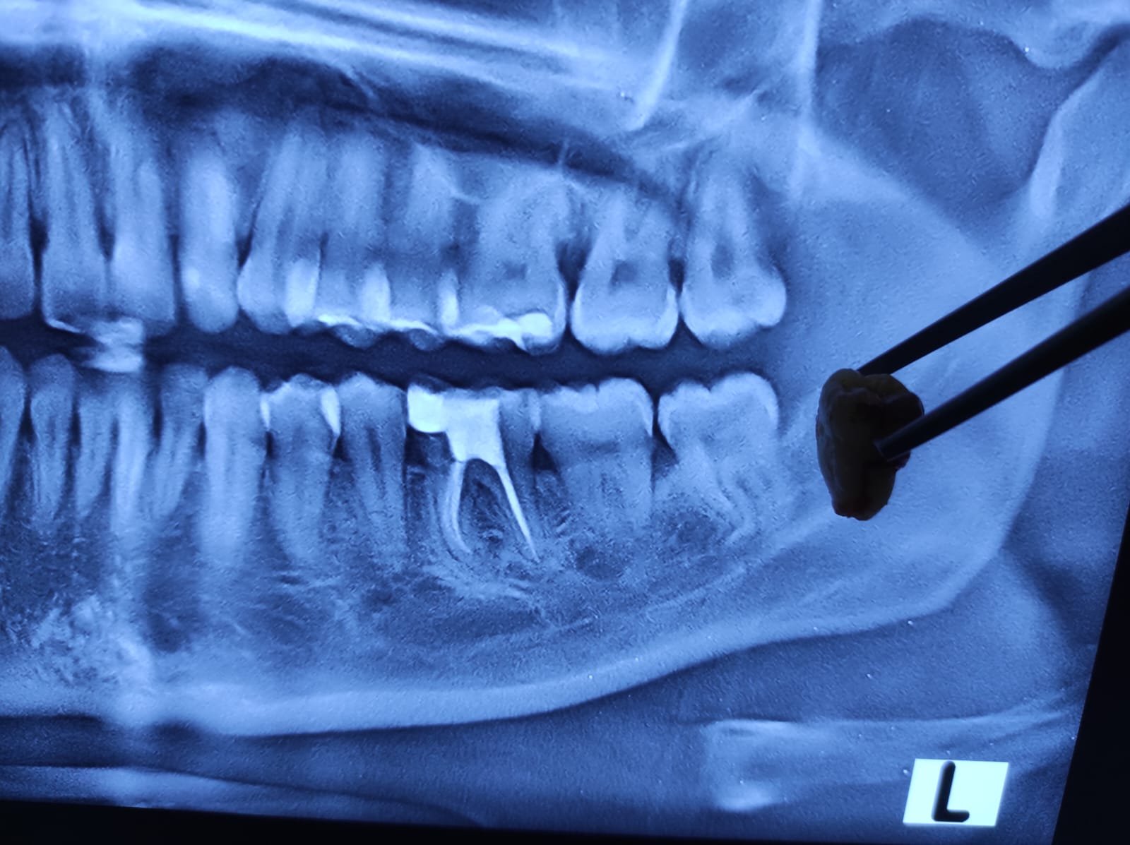 Rontgen panoramic gigi bungsu impaksi rahang bawah