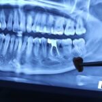 Foto close-up gigi bungsu miring sebelum odontektomi