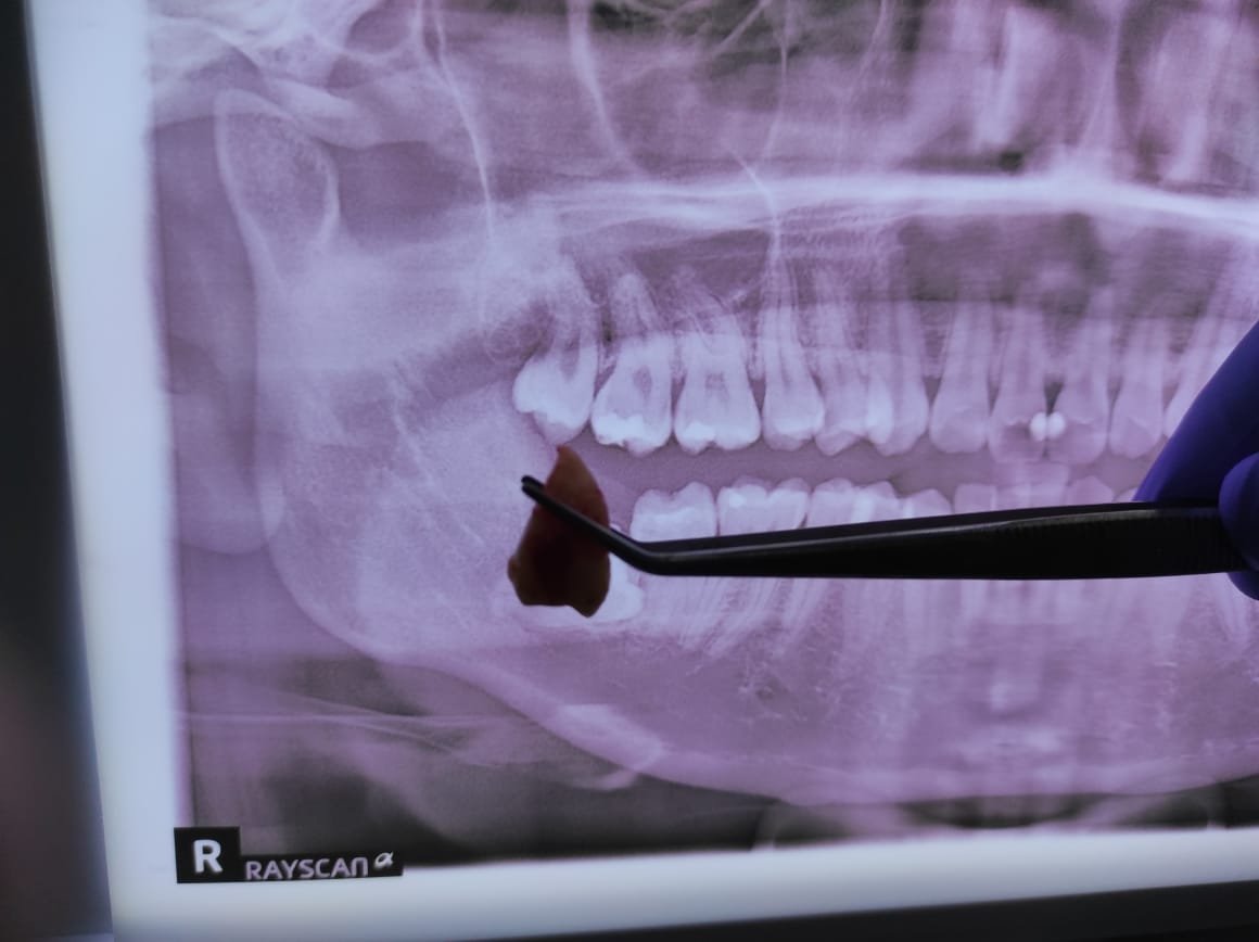 Pasien tersenyum setelah berhasil cabut gigi bungsu di Jakarta