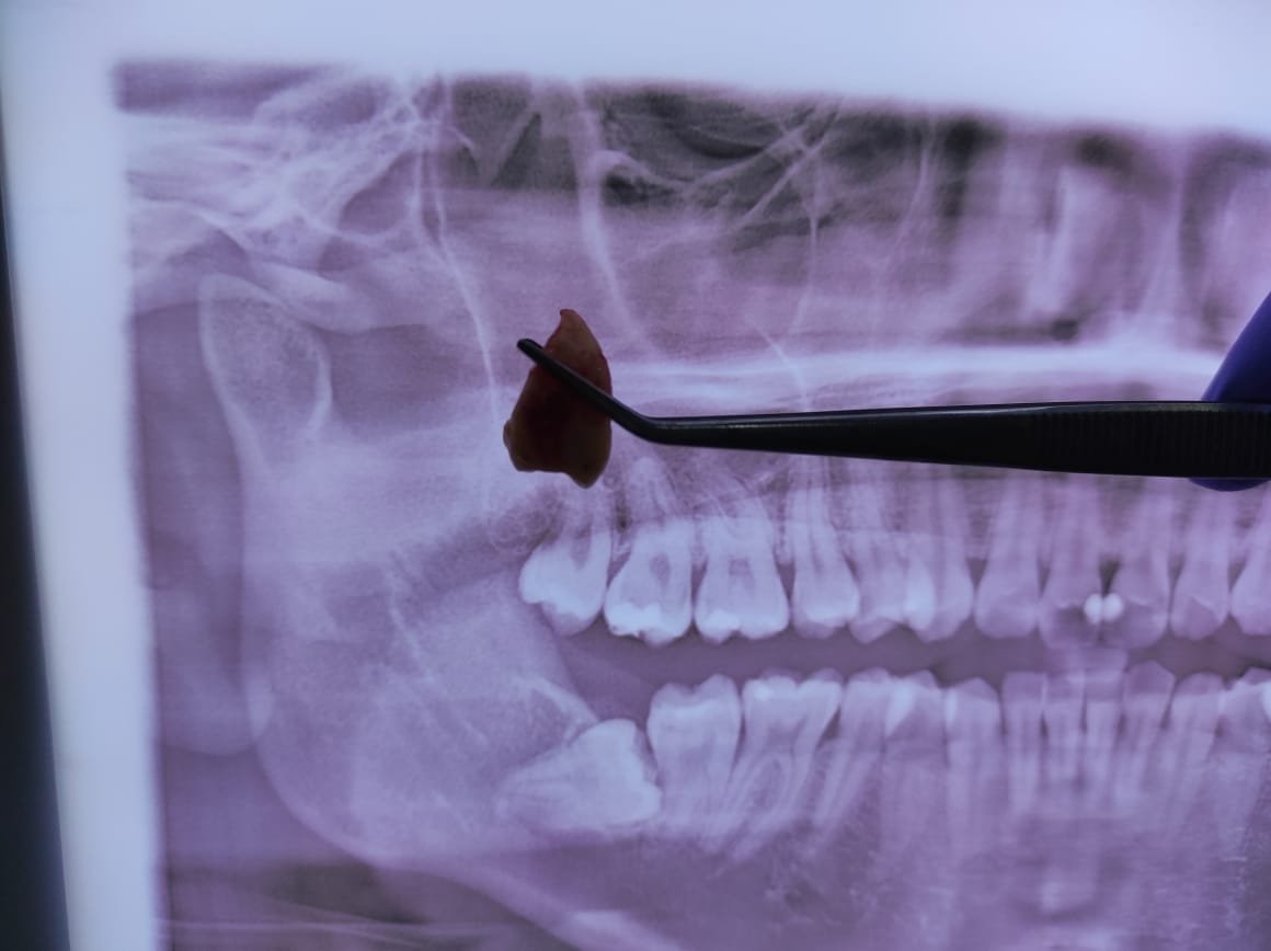 Dokter gigi sedang melakukan odontektomi gigi bungsu di Jakarta