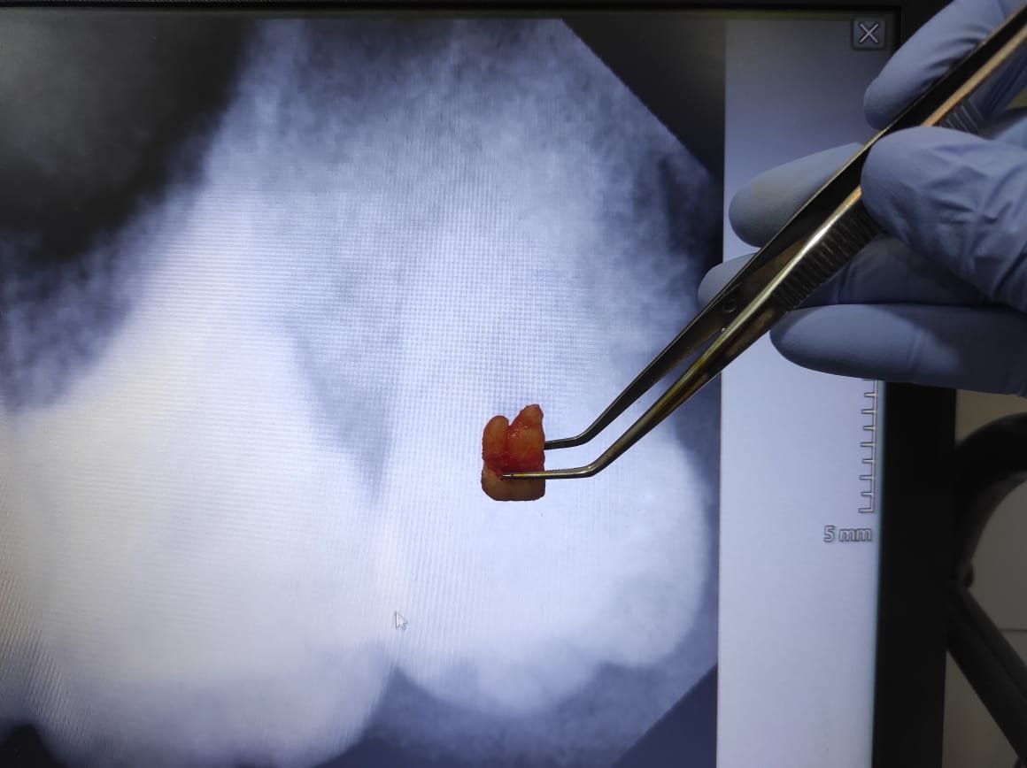 Gigi bungsu bawah yang terjebak di dalam tulang rahang