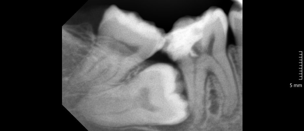 Ilustrasi perikoronitis akibat gigi bungsu tumbuh sebagian