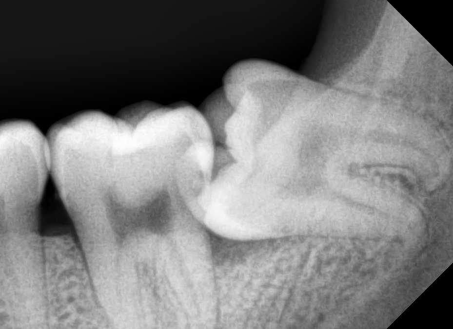 Dokter menggunakan instrumen untuk memotong gigi bungsu