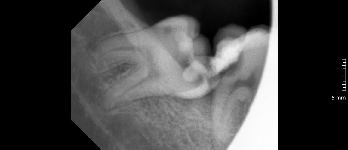 Jahitan pada gusi setelah odontektomi gigi bungsu