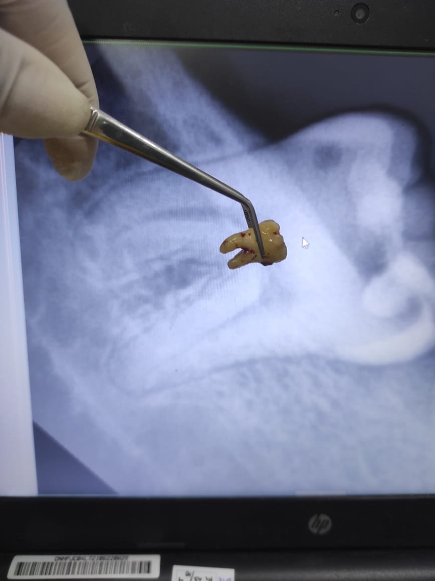 Pasien menggunakan obat kumur antiseptik setelah operasi gigi bungsu