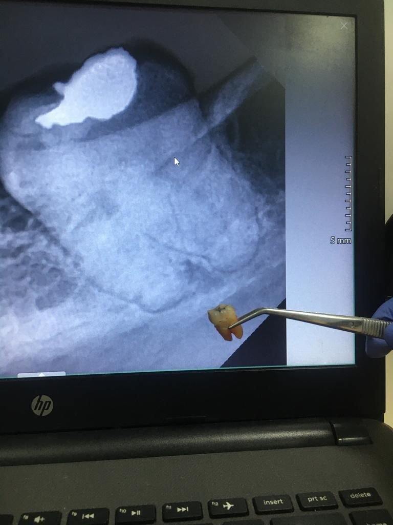 Cover edukasi Apa Itu Odontektomi untuk blog cabut gigi bungsu