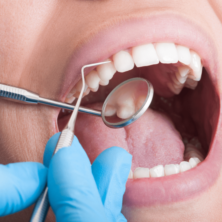 gigi bebas bakteri setelah scaling dan bleaching gigi