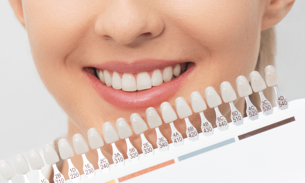 rekomendasi klinik bleaching gigi terbaik di jakarta
