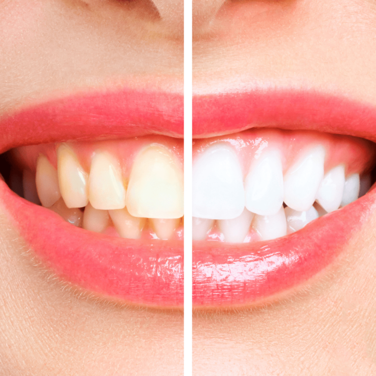 rekomendasi klinik memutihkan gigi kuning terbaik di jakarta