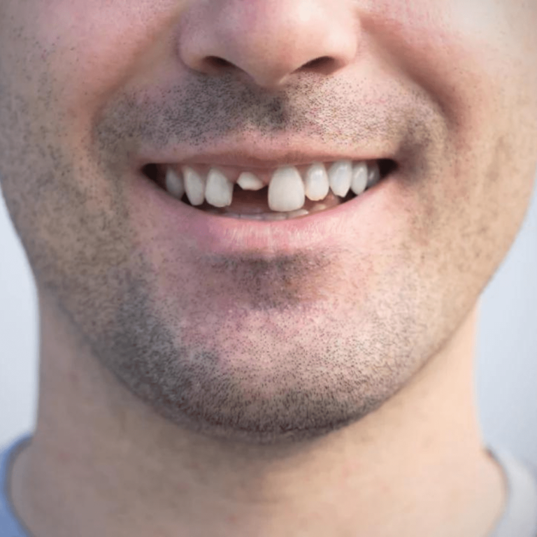 gigi rusak seperti gigi patah, gigi retak, gigi copot, dan gigi lepas