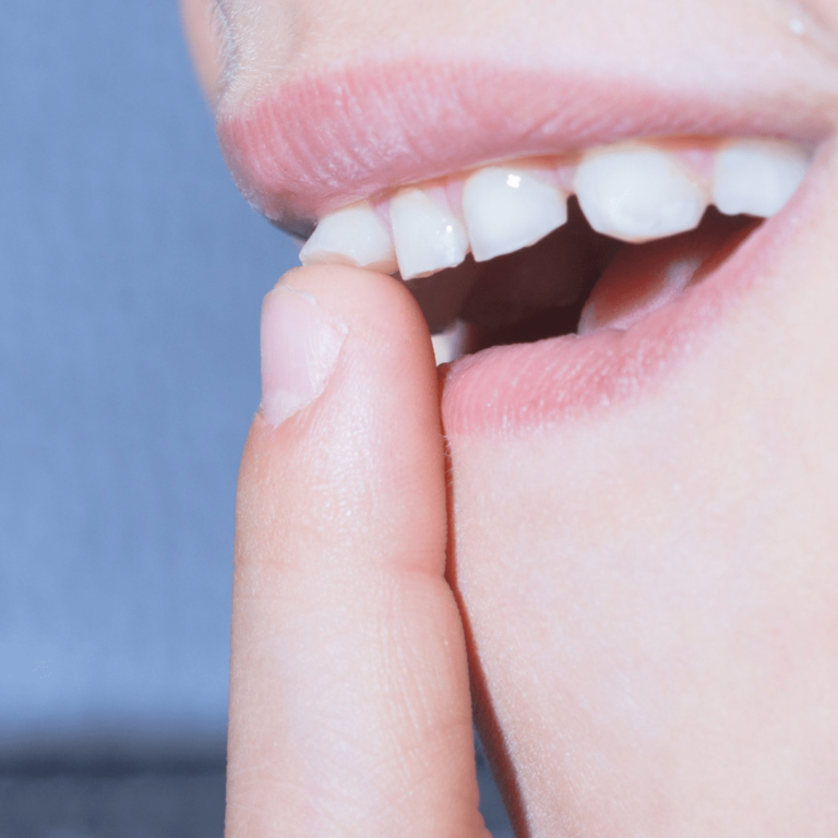 gigi goyang akibat adanya kerusakan gigi
