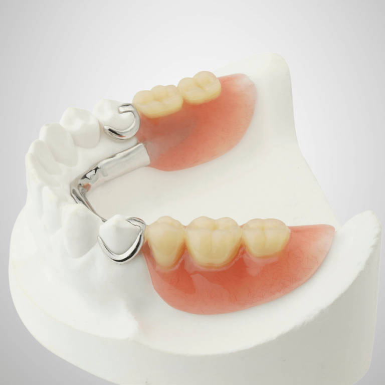 gigi palsu kerangka logam merupakan gigi palsu berbahan metal dan lebih kuat