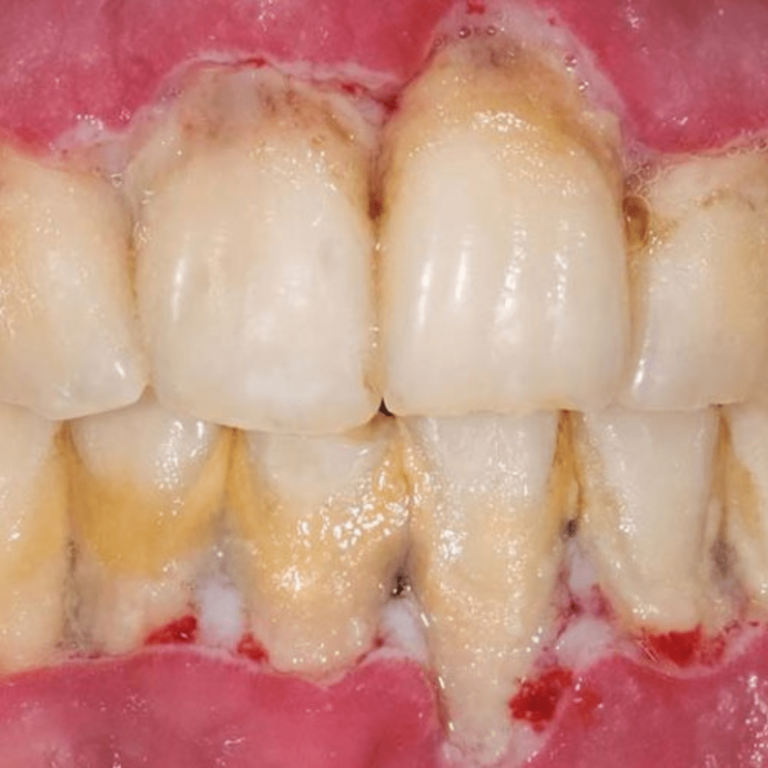 penyakit gusi atau periodontitis