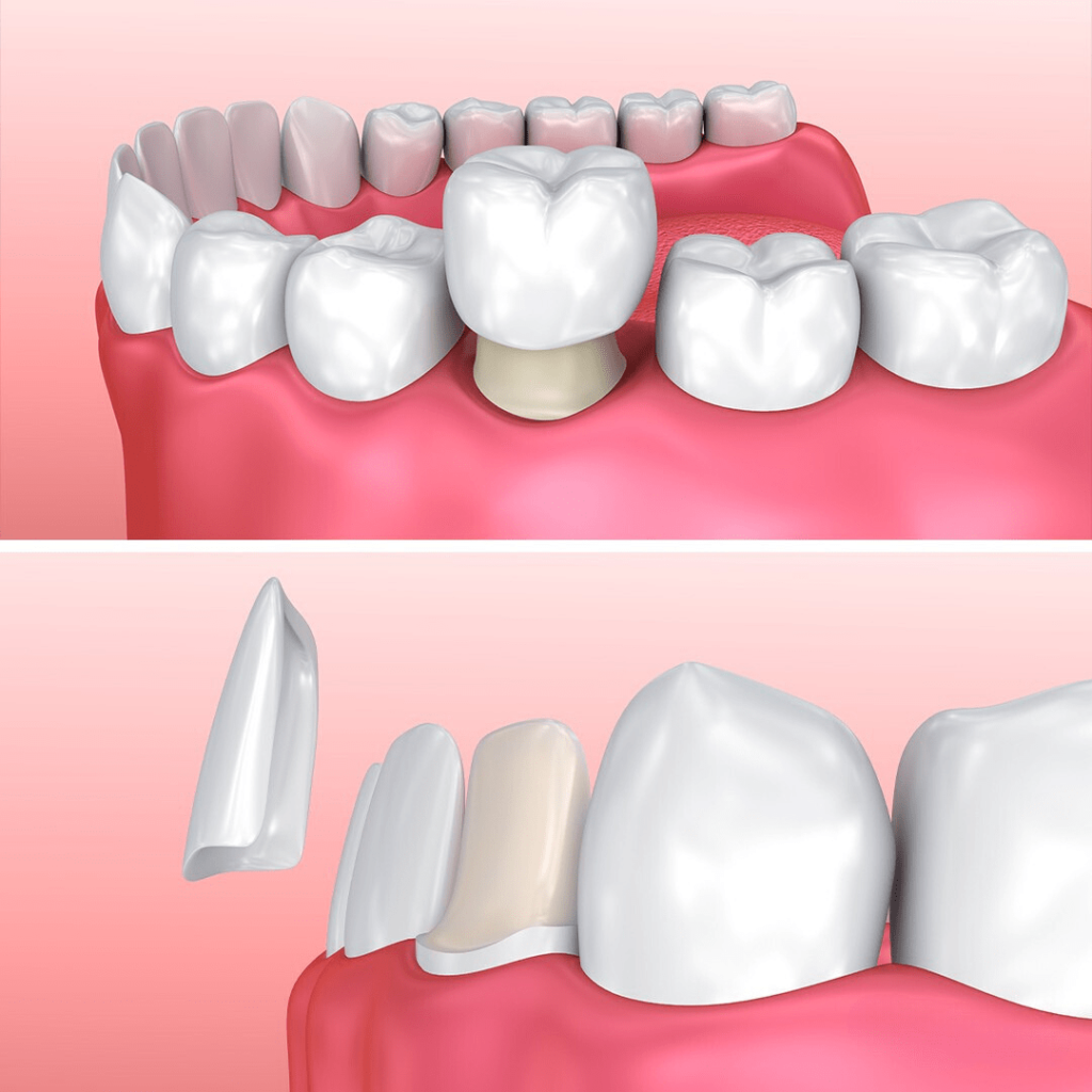 apa perbedaan crown gigi dan veneer gigi