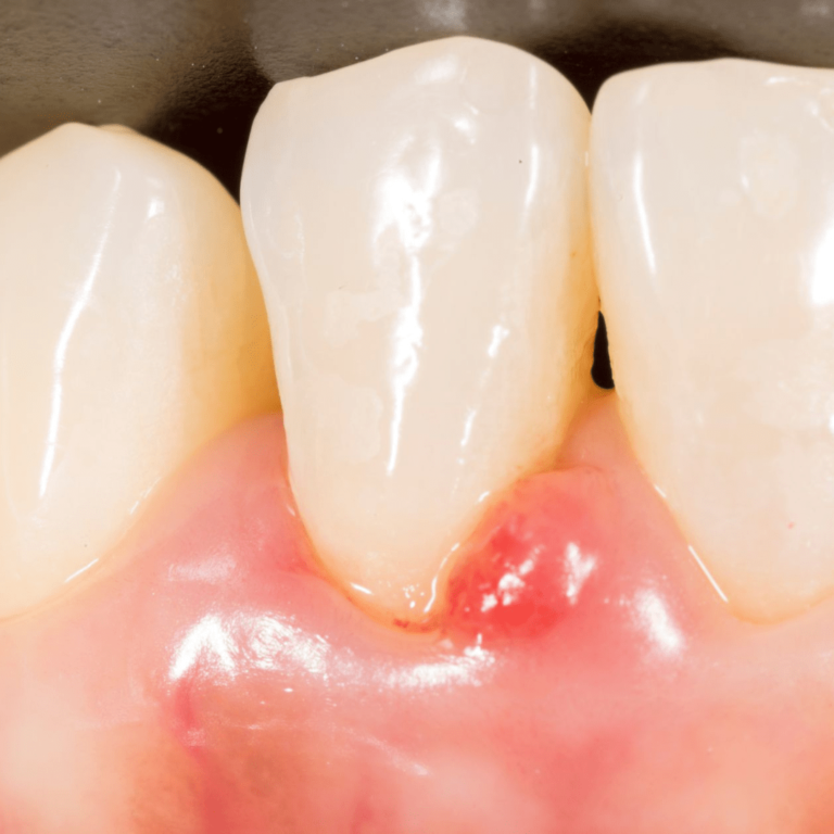 radang gusi terjadi akibat gigi yang tidak sehat