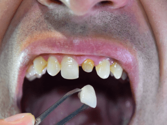 gigi patah akibat insiden harus pasang crown gigi