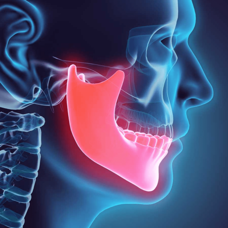 tulang rahang menyusut dan keropos akibat gigi ompong
