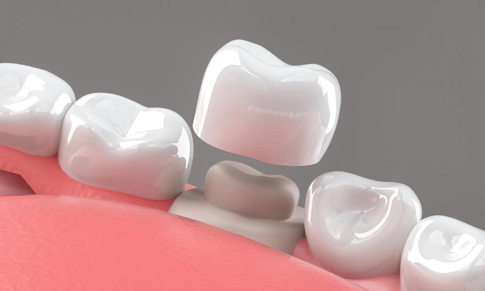 masalah crown gigi yang sering muncul