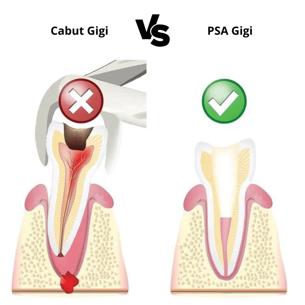 cabut gigi atau perawatan saluran akar gigi, lebih baik yang mana?