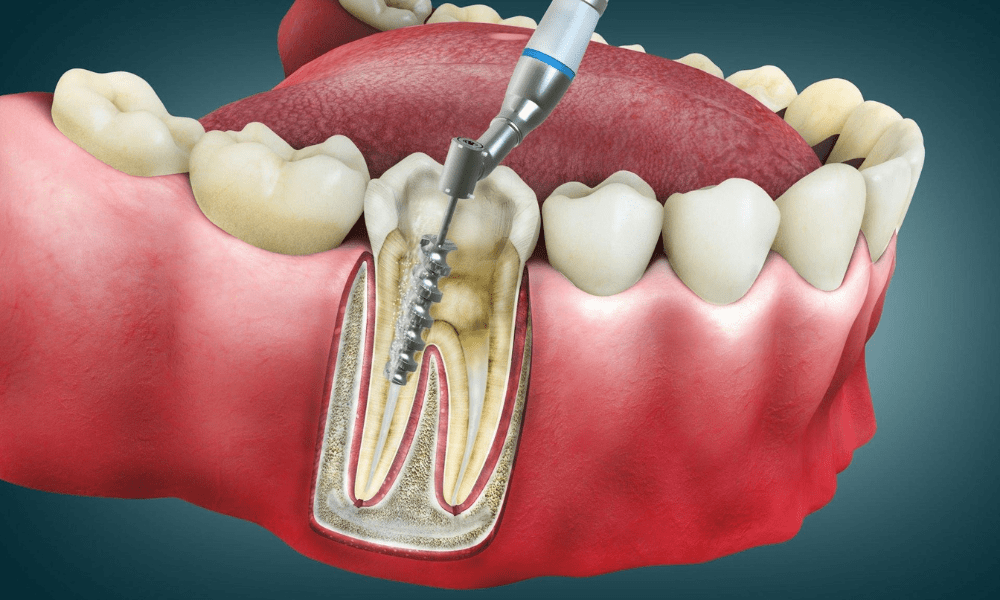 perawatan saluran akar di klinik gigi terbaik di jakarta