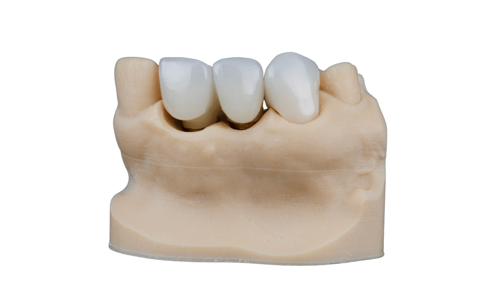 kelebihan dan kekurangan bridge gigi