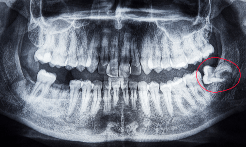 ciri-ciri gigi bungsu tumbuh normal