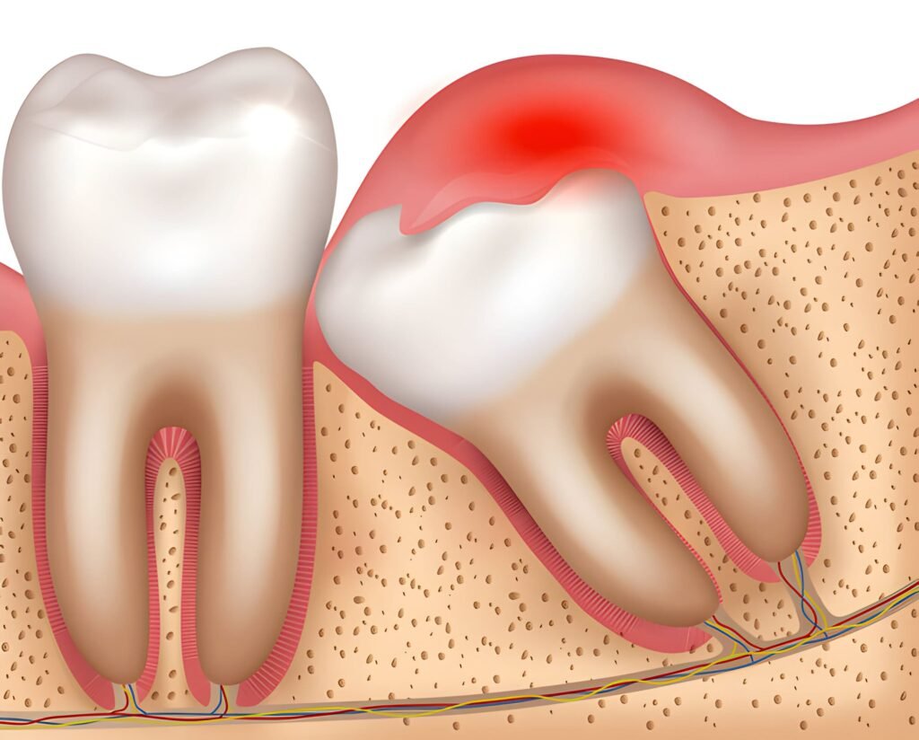 operasi odontektomi gigi merupakan solusi pengobatan untuk gigi bungsu impaksi