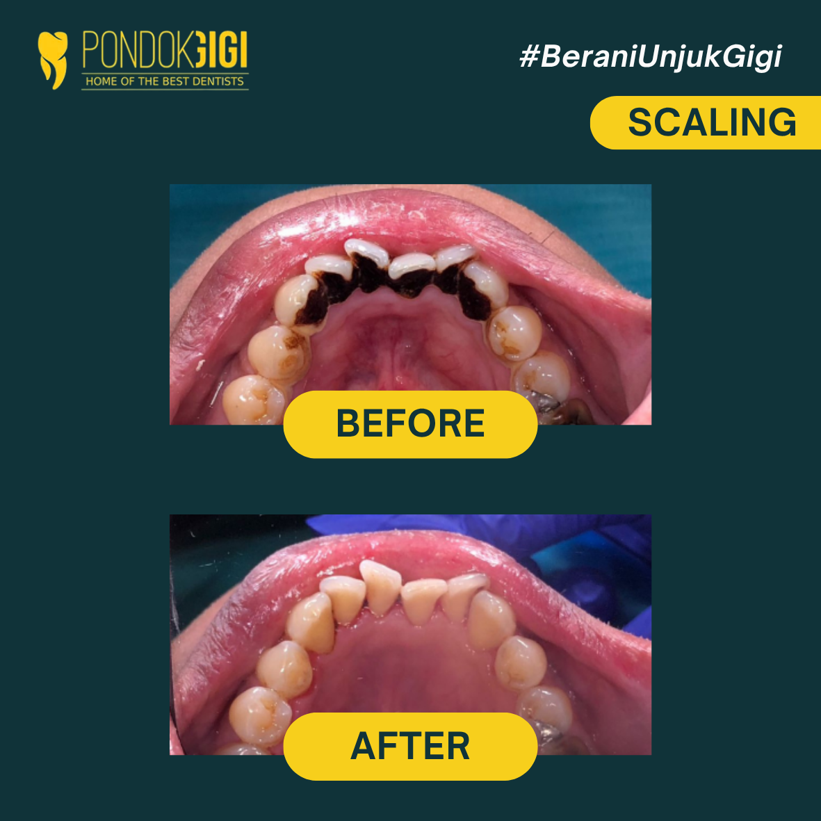 Tempat Scaling Terdekat Terbaik Jakarta, Jakarta Selatan - di Klinik Pondok Gigi