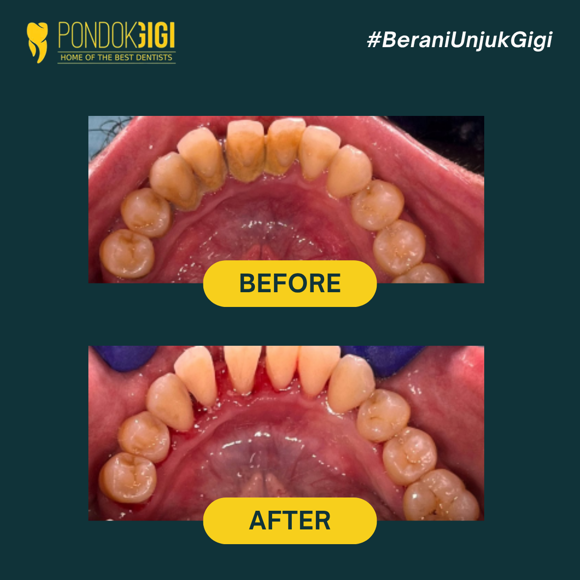 Tempat Scaling Terdekat Terbaik Jakarta, Jakarta Selatan - di Klinik Pondok Gigi