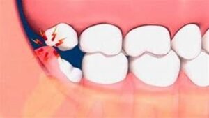 Prosedur cabut gigi bungsu Jakarta di Klinik Pondok Gigi dengan teknologi modern