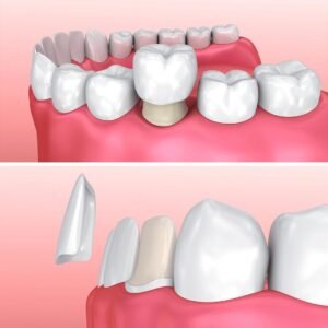 Hasil perbandingan gigi sebelum dan sesudah pemasangan veneer.