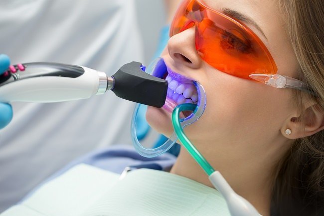 Proses bleaching gigi sedang dilakukan di klinik gigi terbaik dan terdekat jakarta